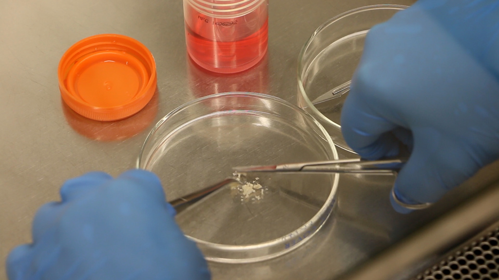 GBM being dissected